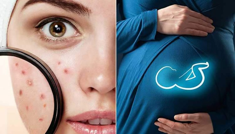 آکنه بارداری