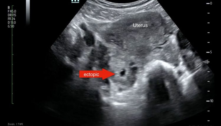 بارداری خارج رحمی