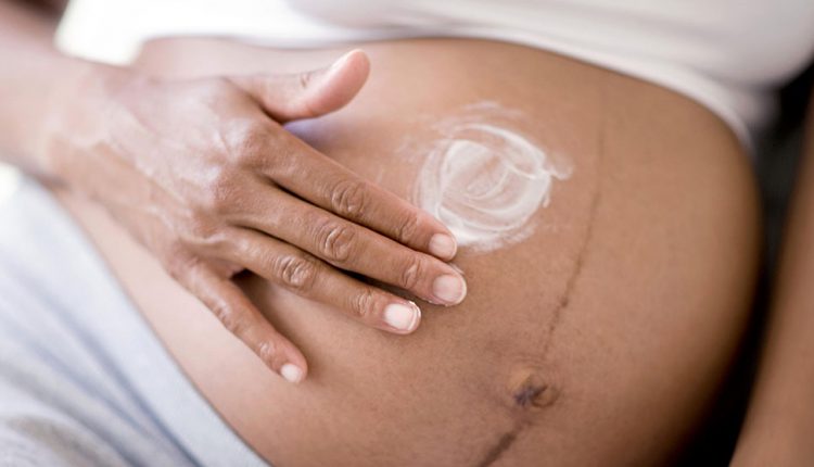 ترک های پوستی در بارداری