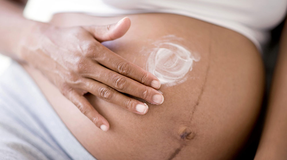 ترک های پوستی در بارداری