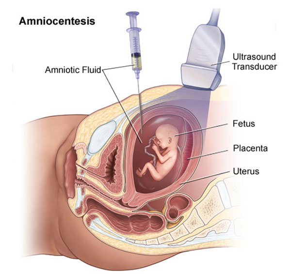 آزمایش آمنیوسنتز در بارداری