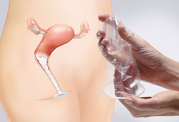 روش استفاده از کاندوم زنانه