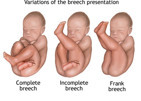 وضعیت بریچ جنین