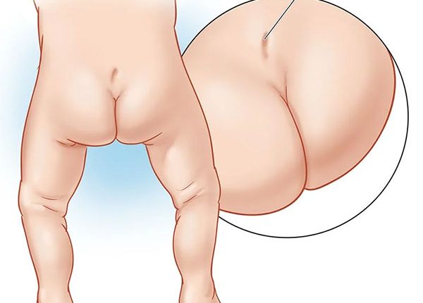 فرورفتگی خاجی